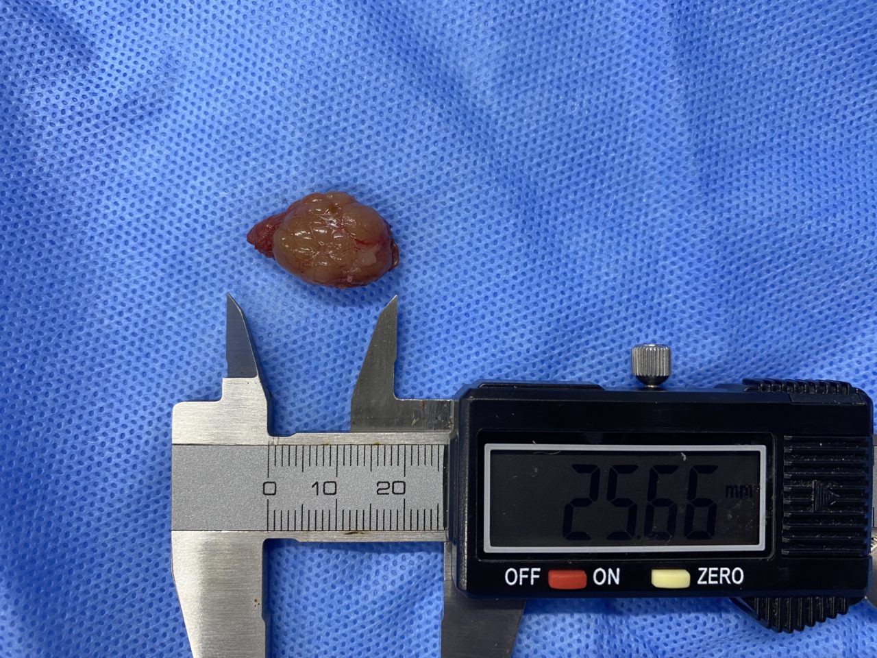 ミオパチー治療の費用と補償範囲