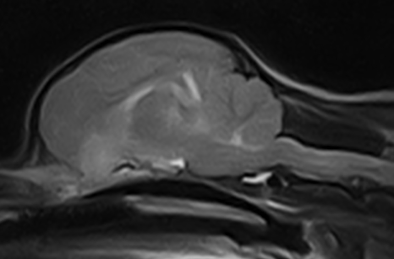 急性出血性白質脳炎の原因は何ですか?
